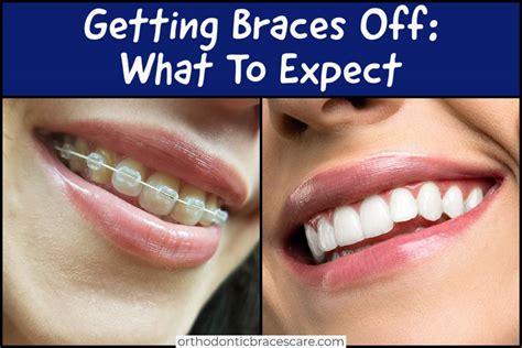 What To Expect When Getting Braces Off Orthodontic Braces Care