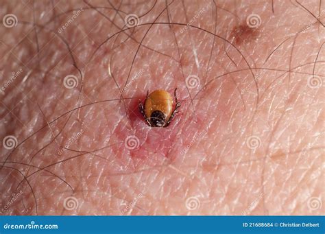 Can A Tick Burrow Under A Dogs Skin