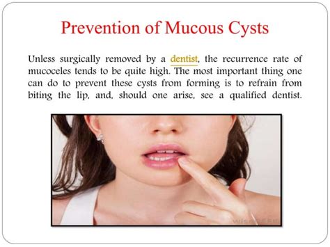 Mucous Cysts Mucoceles Symptoms Causes Treatment And Preventions