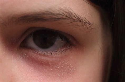 What Causes Dry Eyelids Blepharitis Okotoks Eye Care
