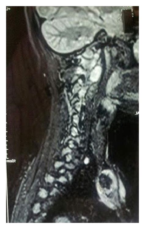 Clinical Picture Showing Erythematous Swelling Over Right Download
