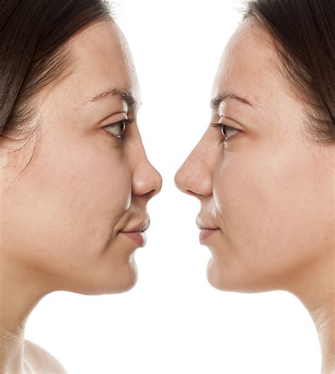 How Long Is Recovery Time For A Nose Job Job Drop