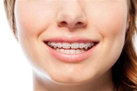Why You Should Consider Clear Braces Frankford Dental Care
