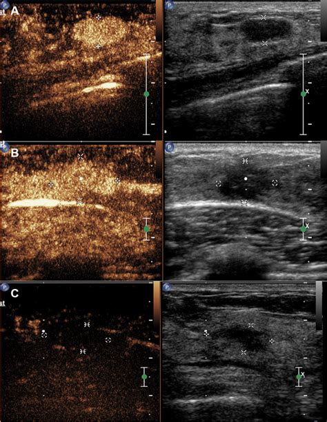 A Multicenter Study Of A Contrast Enhanced Ultrasound Diagnostic Class