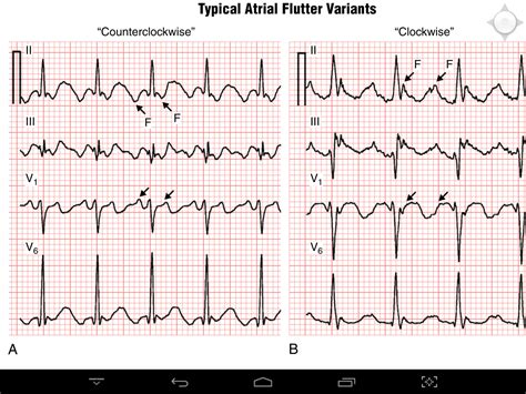 Typical Atrial Flutter Ecg Images And Photos Finder