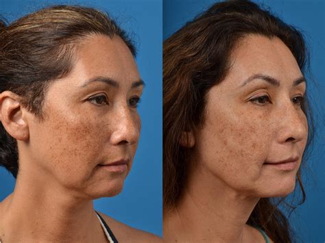 Patient 122406537 Laser Assisted Weekend Neck Lift Before And After