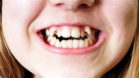 What Causes Crooked Teeth Perelmuter And Goldberg Orthodontics