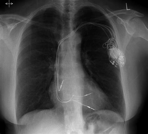 Chest X‐ray Showing A Dual Chamber Pacemaker With A Redundant Right