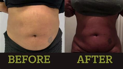 Lipo Cavitation And Non Invasive Butt Lifting Before And After Youtube