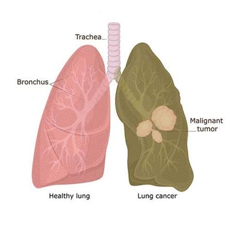 Lung Cancer Symptoms Causes And Treatment Of Lung Cancer