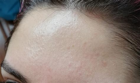 Help My Forehead Has Little Bumps R30plusskincare