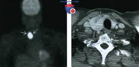 Диета при аденоме щитовидной железы Коллоидная киста щитовидной железы - лучевая диагностика Коллоидная киста щитовидной железы - лучевая диагностика Диета при аденоме щитовидной железы
