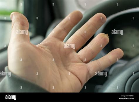 Hand Of A Man With A Missing Finger Phalanx On The Background Of The