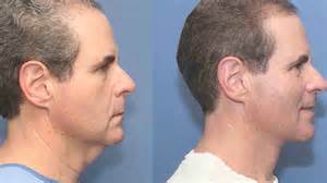 In short, the radio frequency treatment is a neck lift without surgery. New vocabulary term: 'Turkey Neck'. I'd never heard this ...