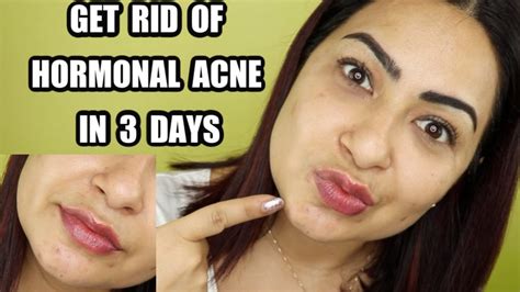 How To Know If Acne Is Hormonal The Hormones That Cause This Type Of