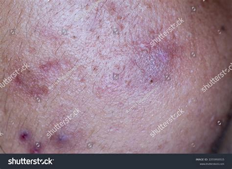 Backgrounds Lesions Skin Caused By Acne Stock Photo 2255950515