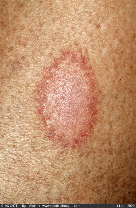 Stock Image Dermatology Tinea Corporis Ringworm An Oval Patch Of Pink