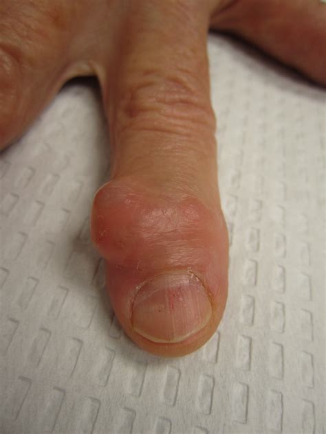 Synovial Cyst Finger Joint