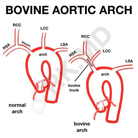 Bovine Aortic Arch Rkmd
