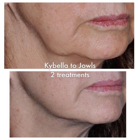 Image Result For Kybella For Jowls Kybella Cosmetic Dermatology