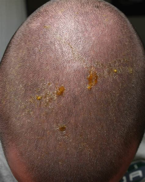Sunburn On Scalp Causes Symptoms Treatment Prevention And More