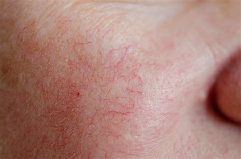 Red Veins Skin Conditions Leicester