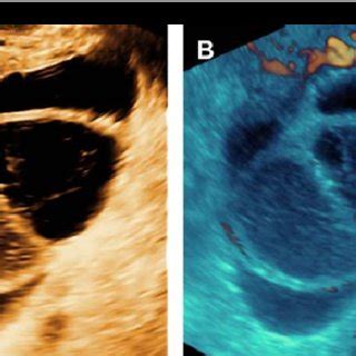 Ultrasonography Useful In Abscess Management When Hot Sex Picture