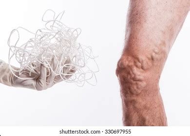 Human Leg Blocked Veins Thrombosis Phlebitis Stockfoto 330697955