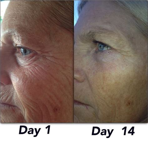 Neriumad Before And After Skin Care 1