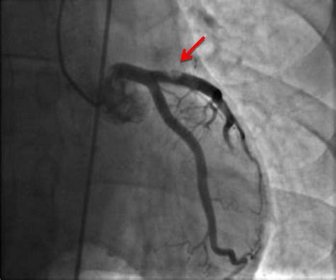 Coronary Angiography Showing A Large Thrombus In The Left Anterior