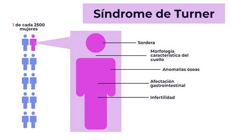 S Ndrome De Turner Qu Es Y C Mo Se Diagnostica Genotipia