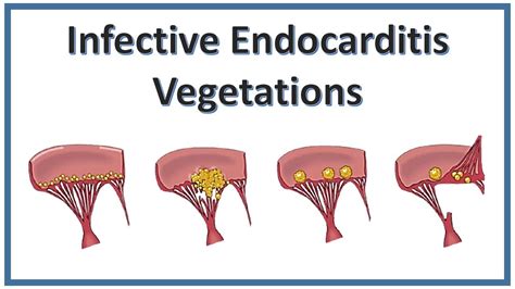 Vegetations Infective Endocarditis Neet Pg Pathology Medicine