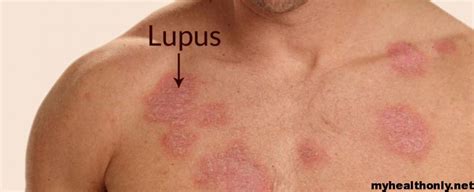 Lupus Symptoms Causes Diagnosis Treatment And Complications