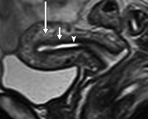 Mri Characteristics Of The Uterine Junctional Zone From Normal To The