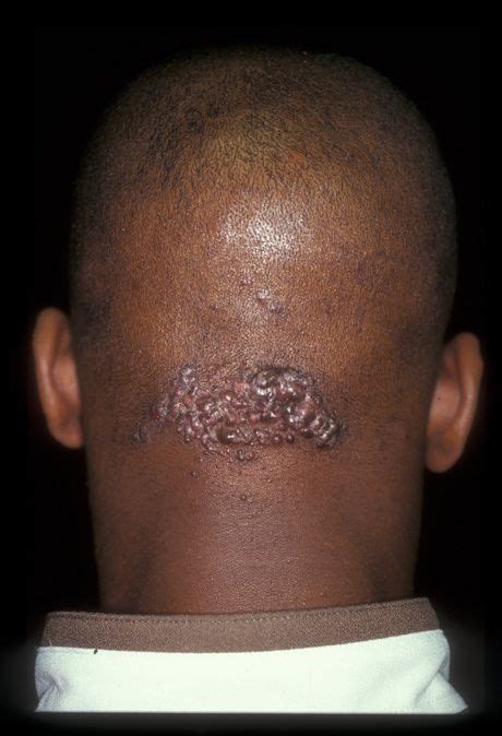 Are Bumps Located At The Lower Hairline Just Above The Neck As A Result