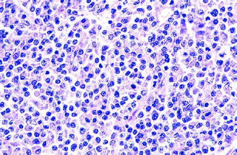 Low Grade B Cell Lymphoma Of The Dura Malt Type High Power Field