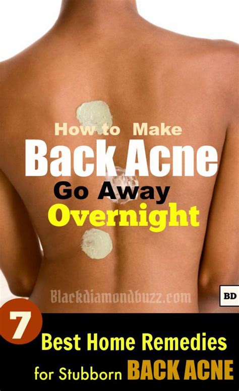 How To Get Rid Of Back Acne Fast 7 Best Home Remedies For Backne