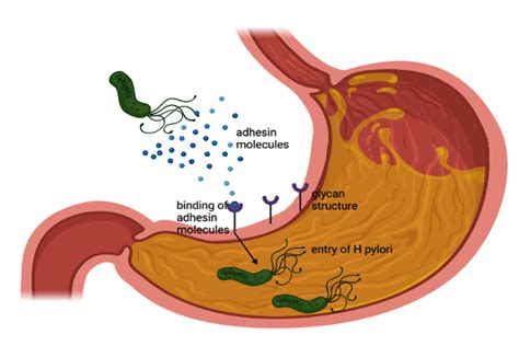 Management Of H Pylori Induced Peptic Ulcer A Phytotherapeutic