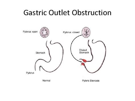 Gastric Outlet Obstruction And Its Surgical Management Definition