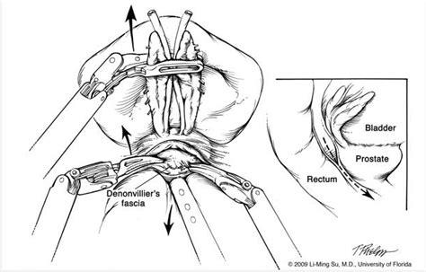 Robotic Nerve Sparing Radical Prostatectomy Department Of Urology