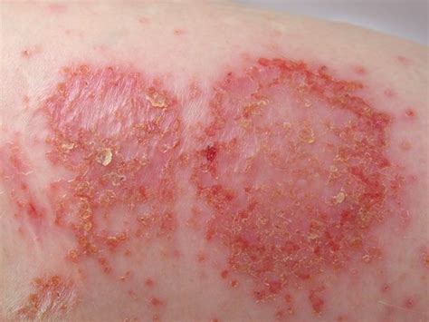 Nummular Eczema Causes Symptoms Treatment Pictures Healthmd
