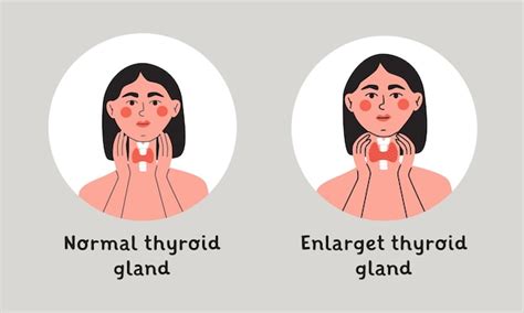Premium Vector Normal And Enlarget Thyroid Gland Woman Showing
