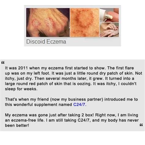 C247 On Discoid ‪‎eczema‬ C247 Testimonials Pinterest Best