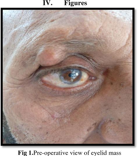 Pdf Epidermoid Cyst Of The Eyelid A Case Report And Review Of