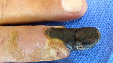 Gangrene In A Surgical Wound