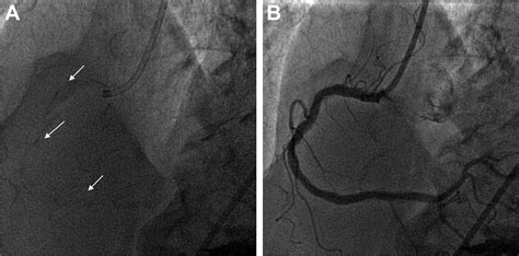Coronary Artery Calcification Pathogenesis And Prognostic Implications