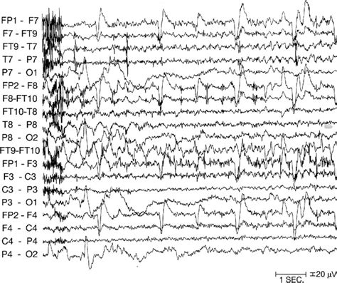 New Onset Mesial Temporal Lobe Epilepsy In A 90 Year Old Clinical And Eeg Features Epilepsy