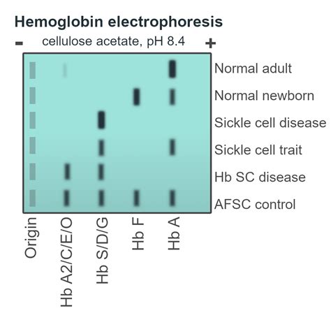 Hemoglobin Electrophoresis Wikiwand