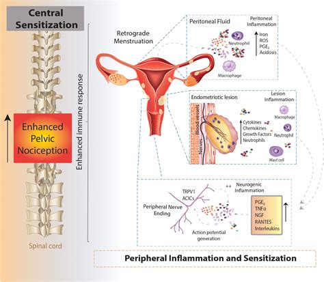 Pathophysiology Of Pain In Patients With Peritoneal Endometriosis My XXX Hot Girl