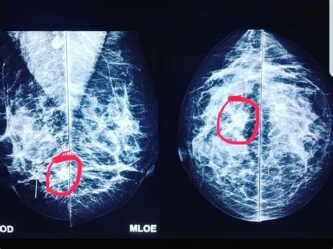 Clínica Única Exames Mamografia Magnificação De Mamas Compressão